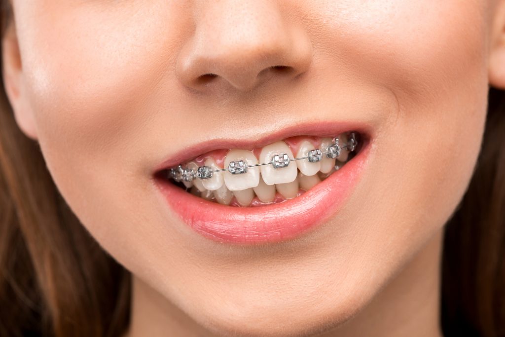tipuri de aparat dentar