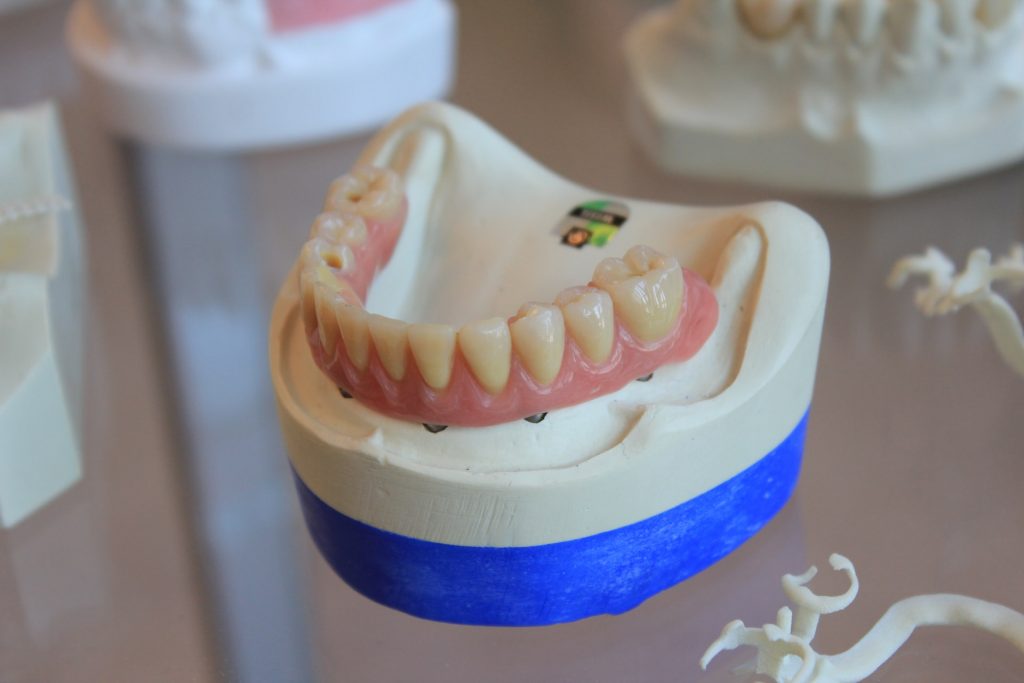 garantie implant dentar vs proteza dentara