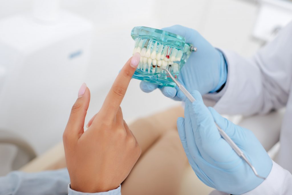 ce sunt implanturile dentare
